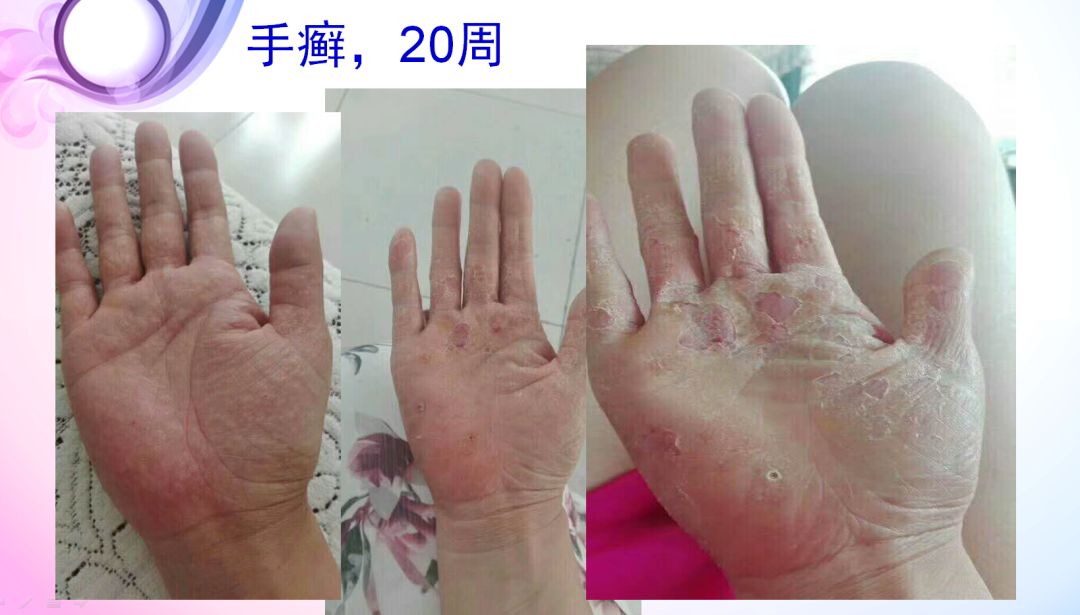 肝病患者补硒治愈视频