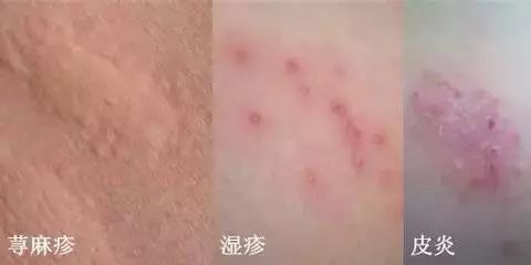 补硒后全身痒怎么回事