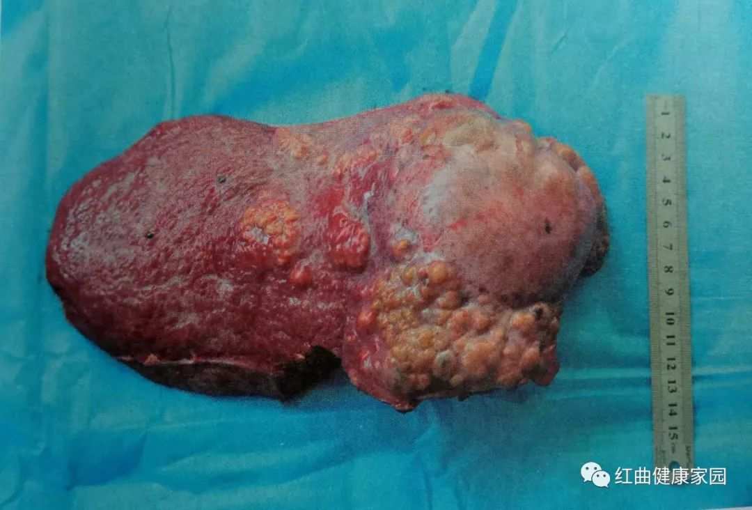 癌症患者怎么适当补硒