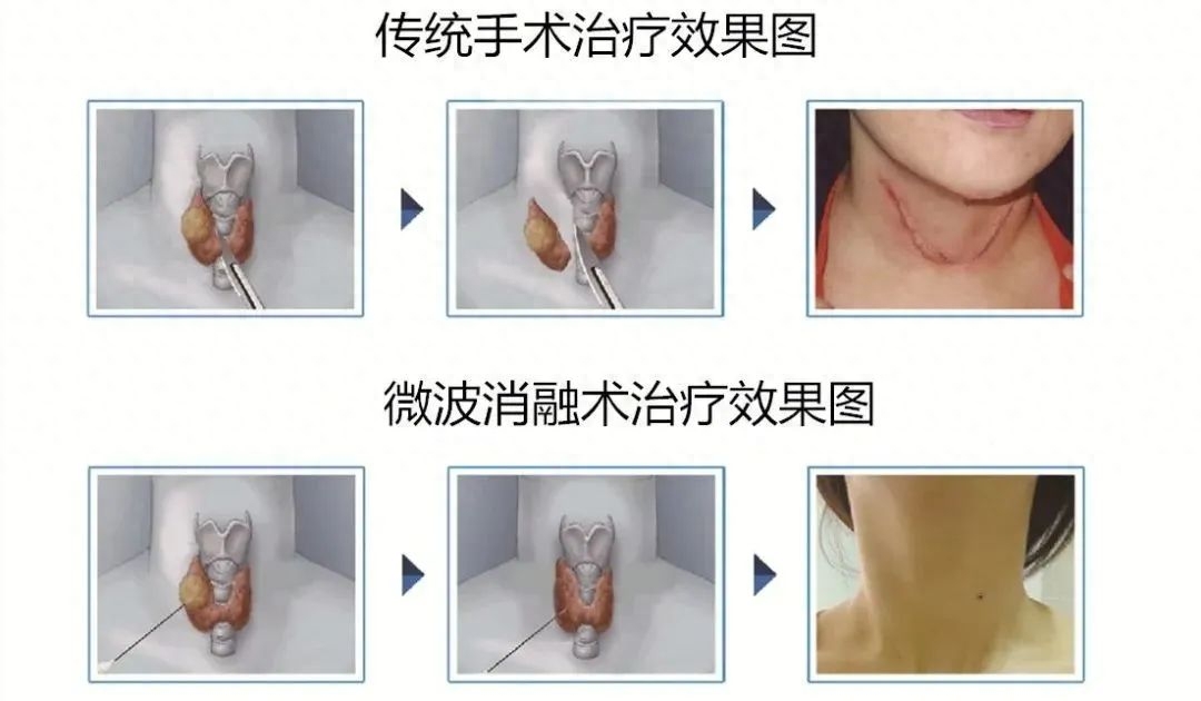 甲亢每天补硒多少毫克