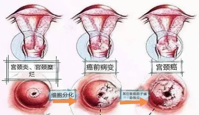 hpv感染补哪种类硒