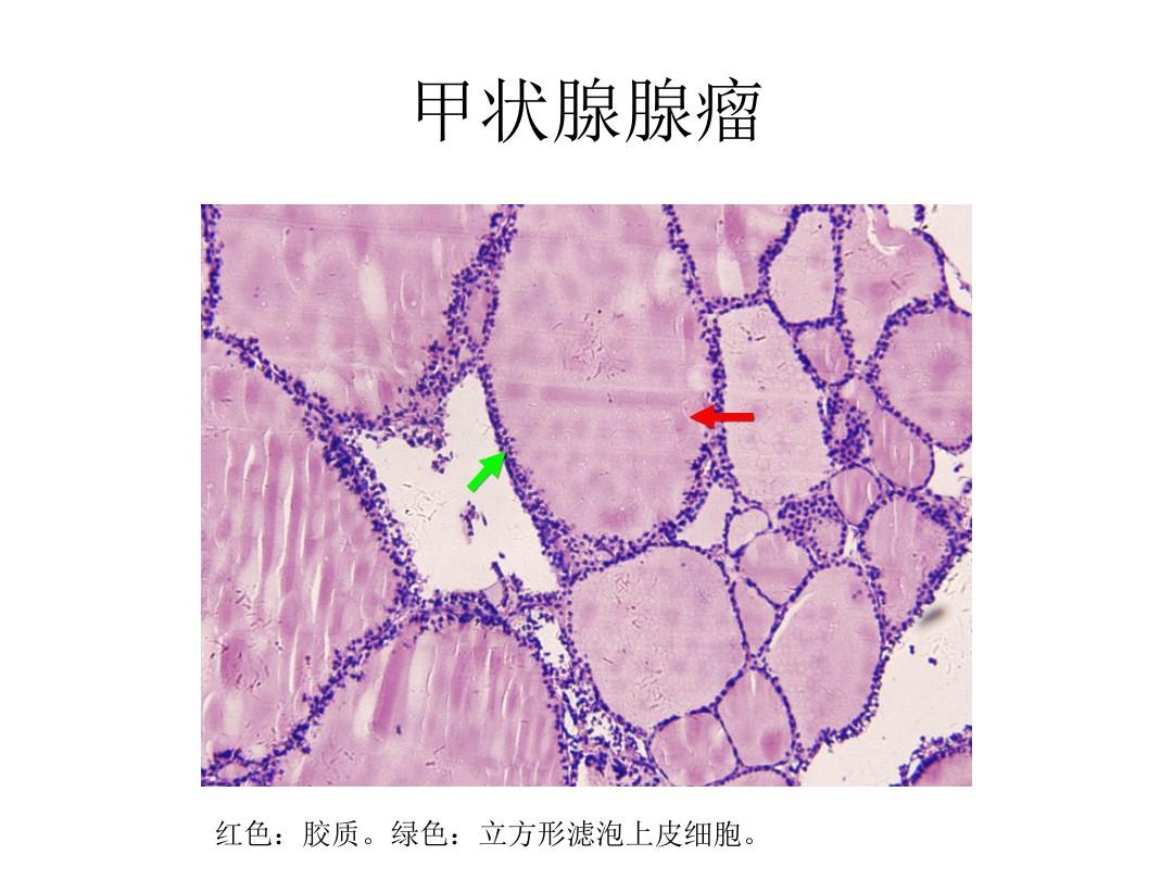 甲状腺结节是否要补硒