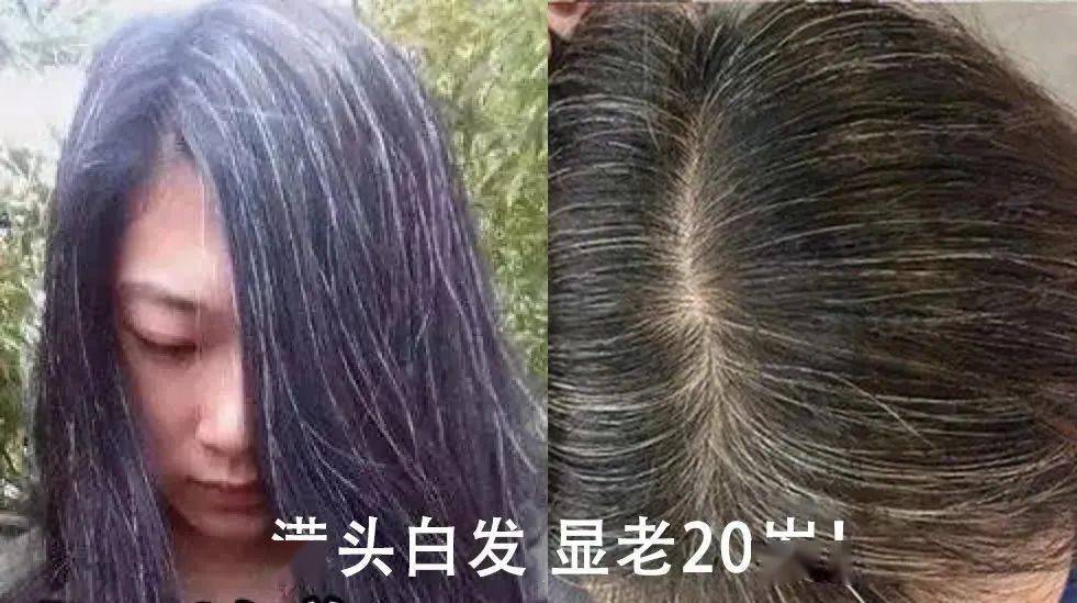 补硒元素能治疗白发吗