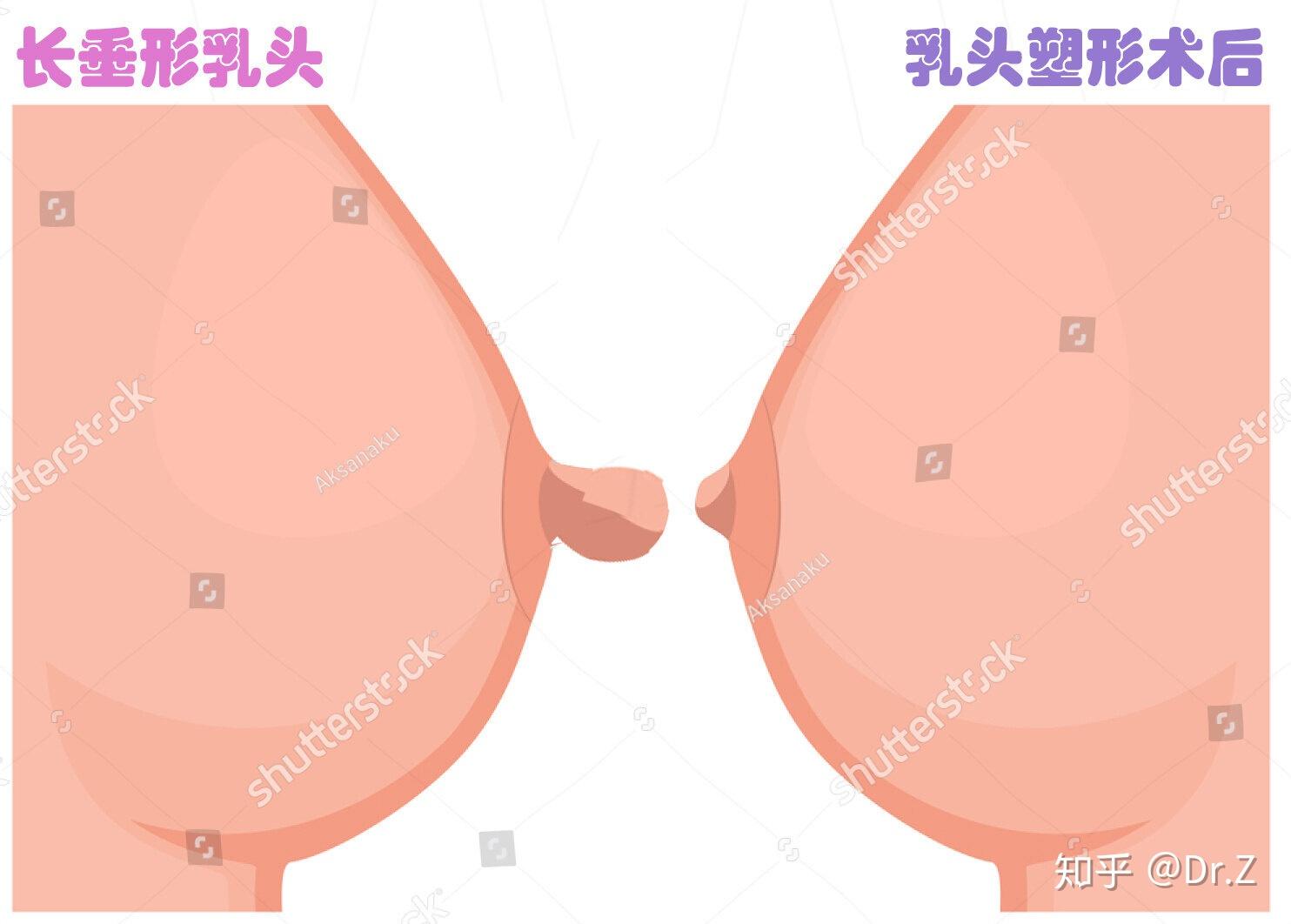 为什么补硒过后乳房痛