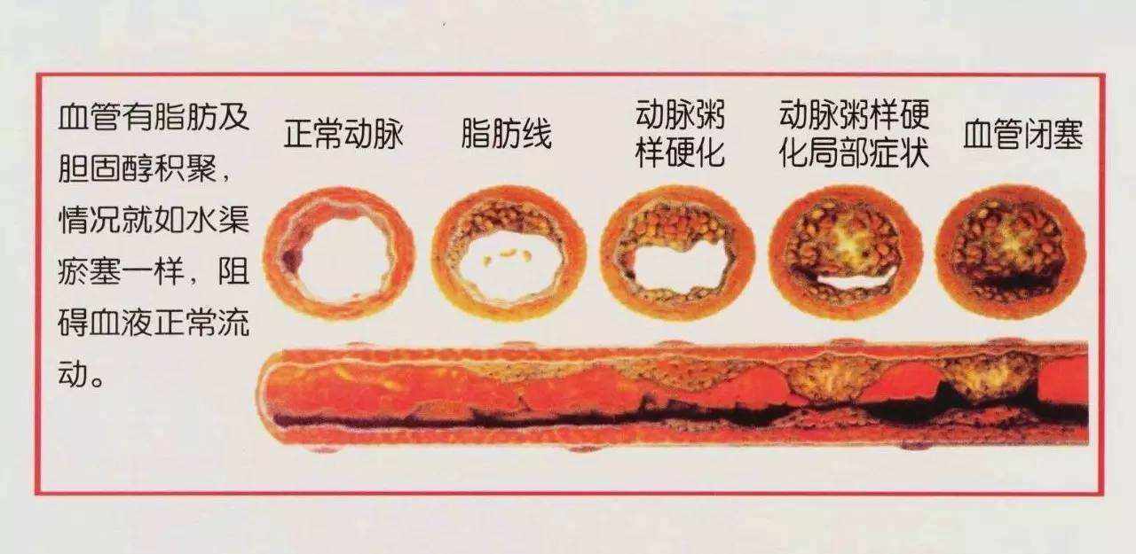 血脂异常还可以补硒嘛