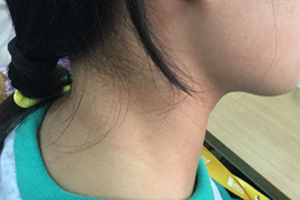 补硒药可以治甲状腺嘛