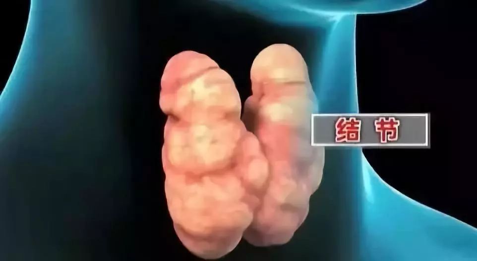 甲状腺结节补硒好不好