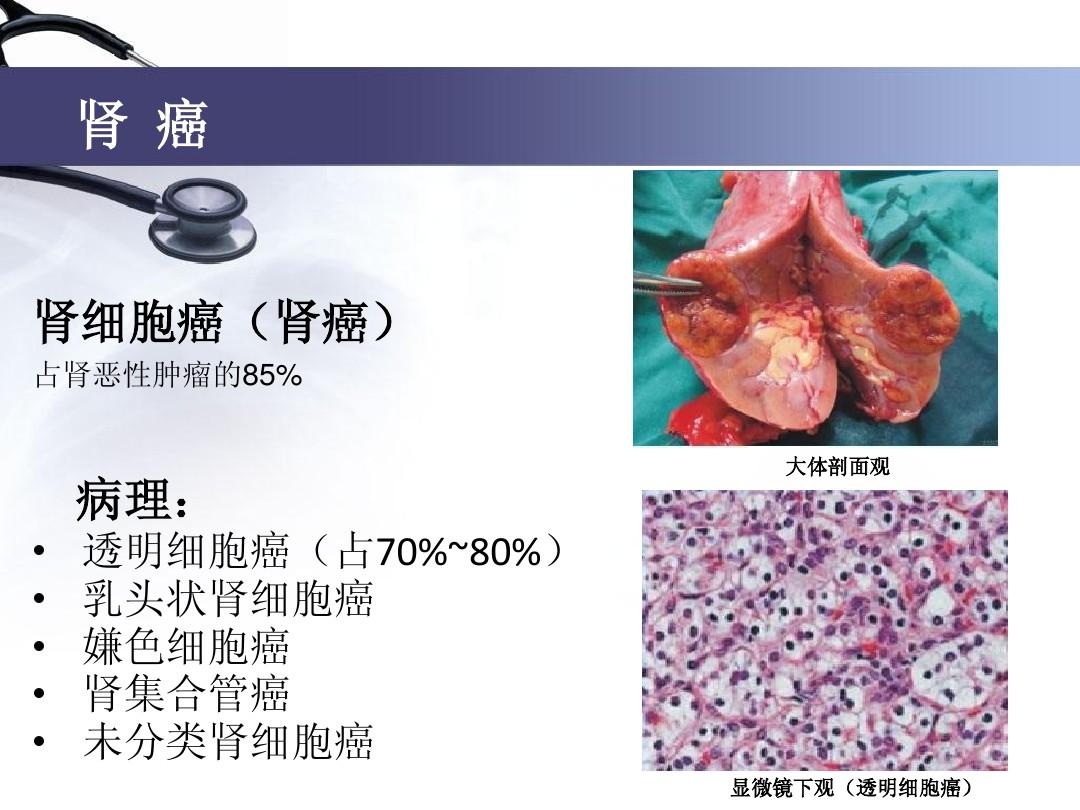 肾盂癌术后可以补硒吗