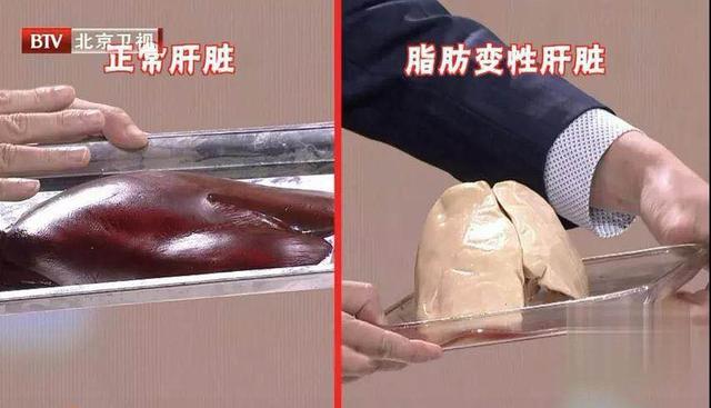 血脂异常还可以补硒吗