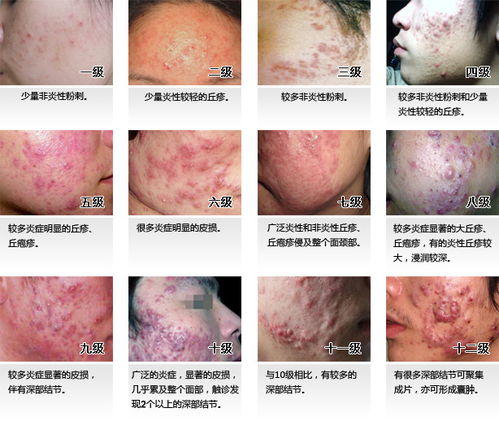 补硒对皮肤瘙痒有用吗