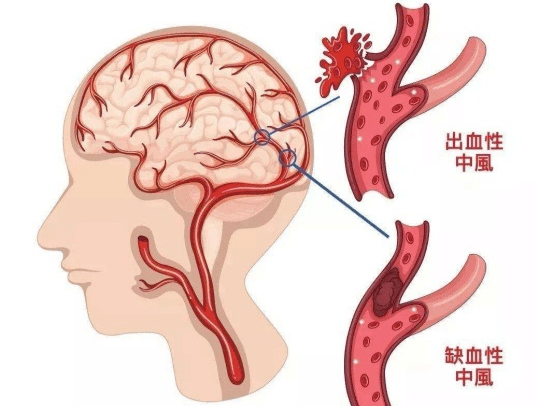 脑出血病人补硒重要吗