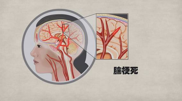 脑出血病人补硒重要吗