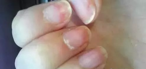 指甲发白补硒