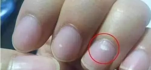 指甲发白补硒