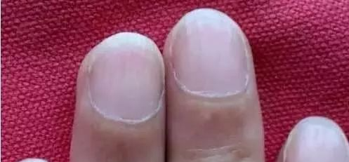 指甲发白补硒
