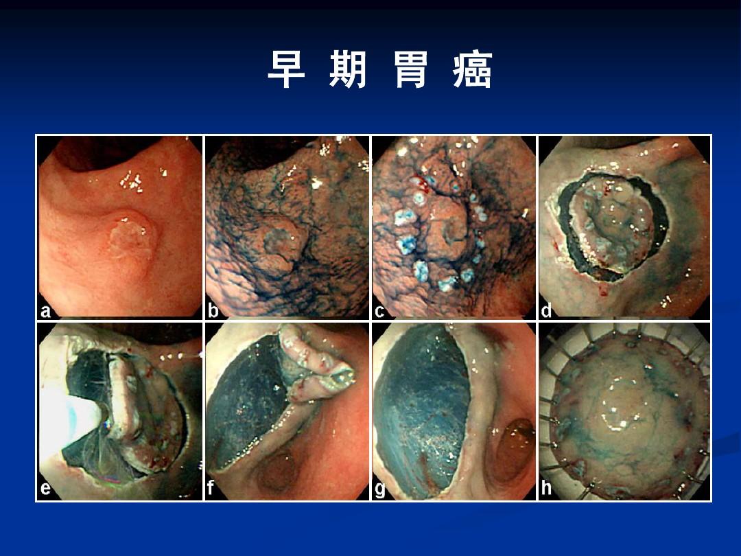 肺癌转移补硒
