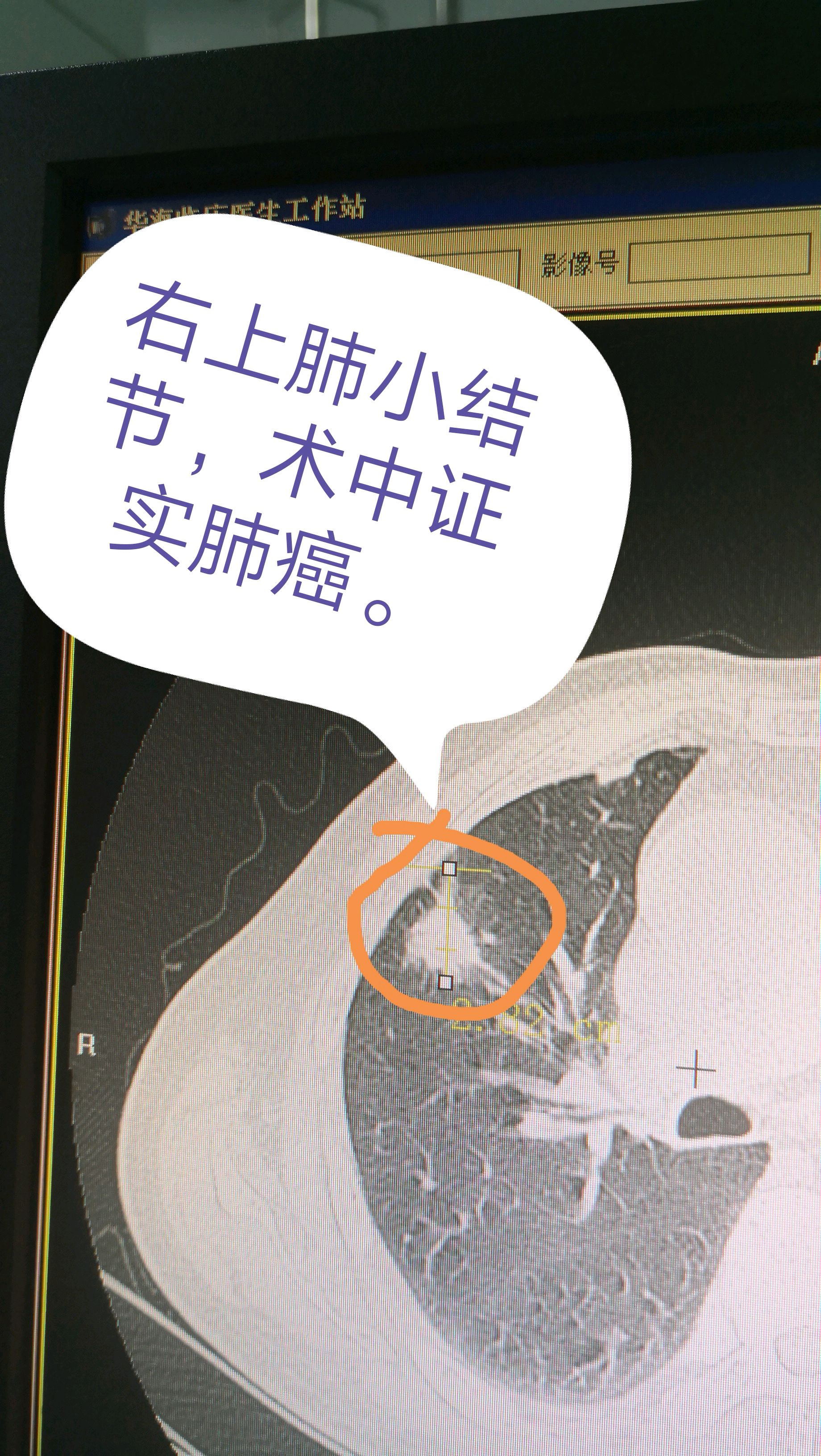 食道癌 补硒