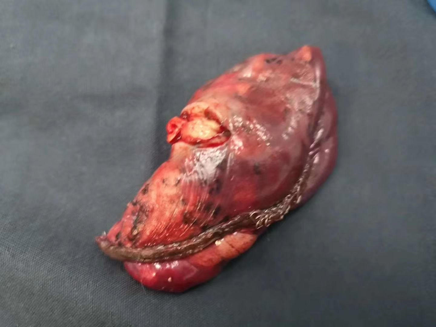 食道癌 补硒