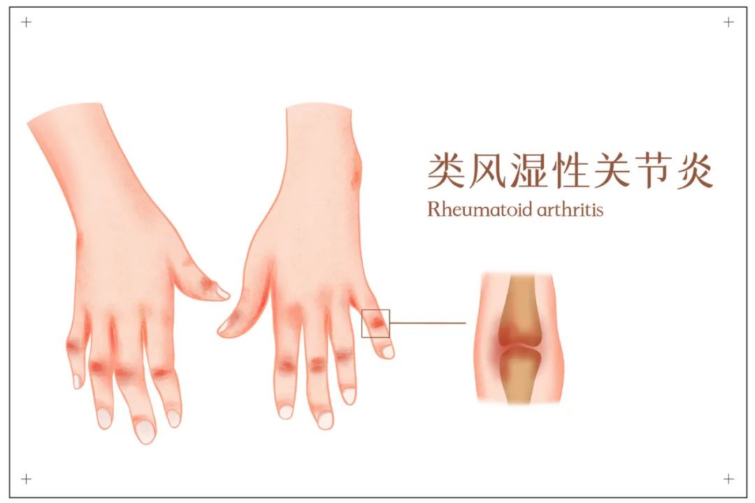 补硒与关节痛