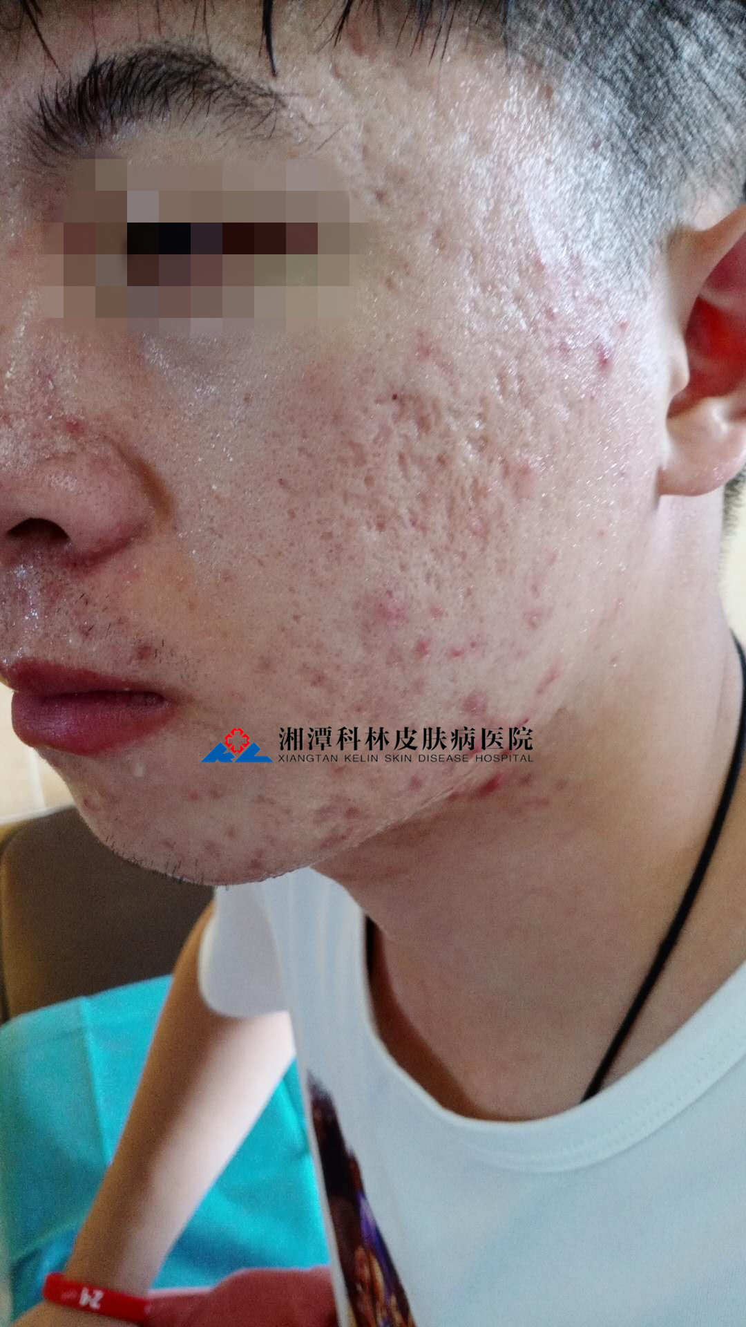 胃寒能补硒吗