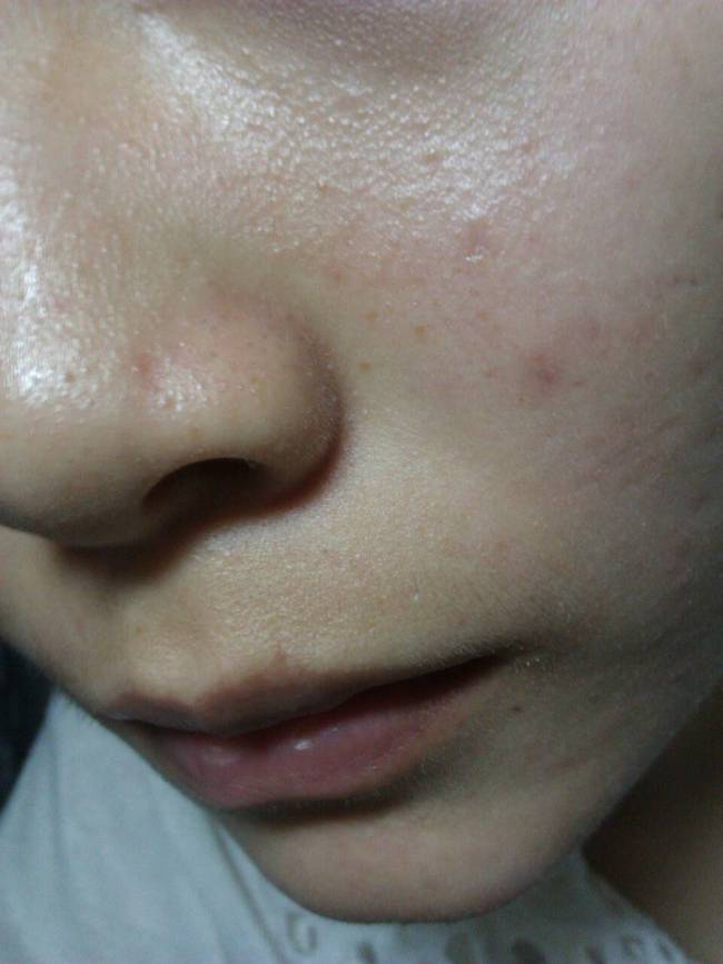 女生补锌会增加雌性激素吗