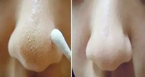 吃鸡蛋壳补钙吗