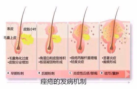 脸上有痤疮要补锌多久