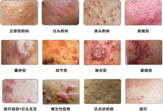 脸上有痤疮要补锌多久