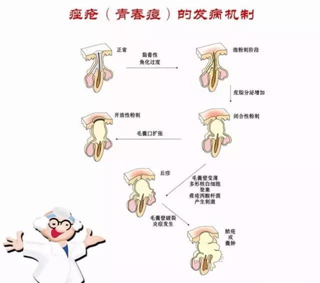 脸上有痤疮要补锌多久