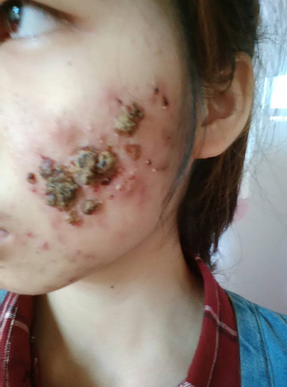 脸上有痤疮要补锌多久
