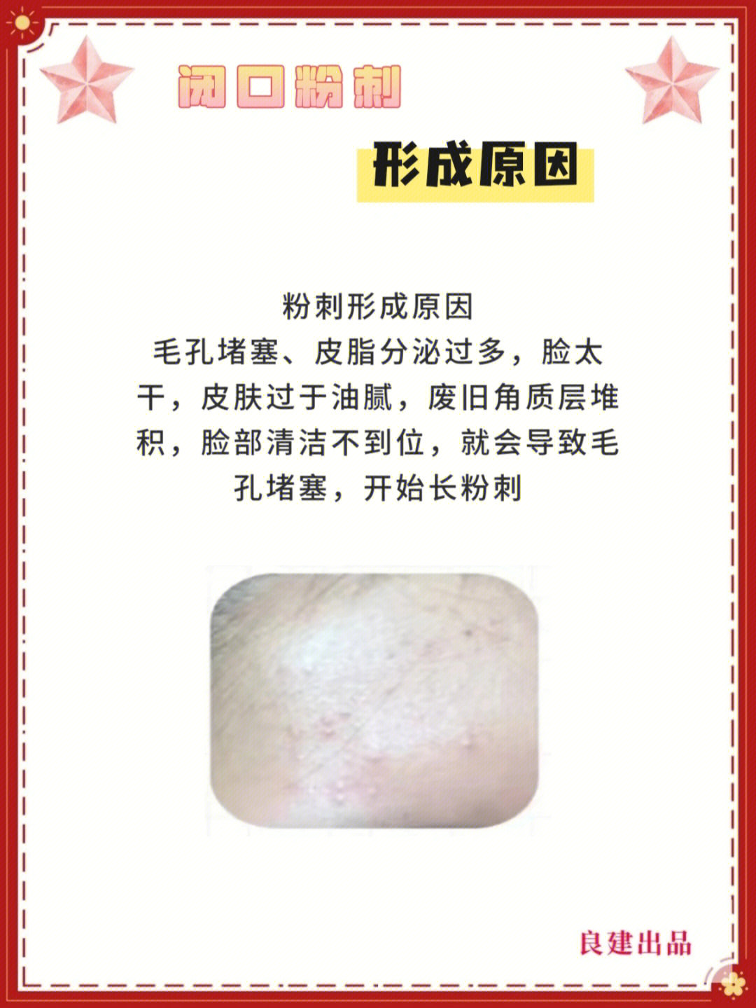 脸上有痤疮要补锌多久