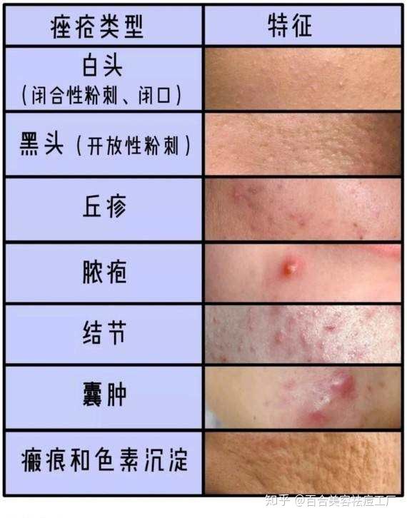 脸上有痤疮要补锌多久