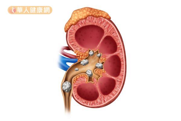 补钙过量会有什么症状