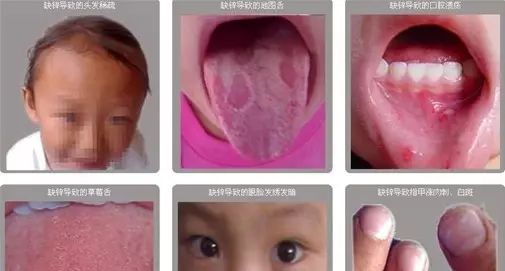 吃了锌硒宝片