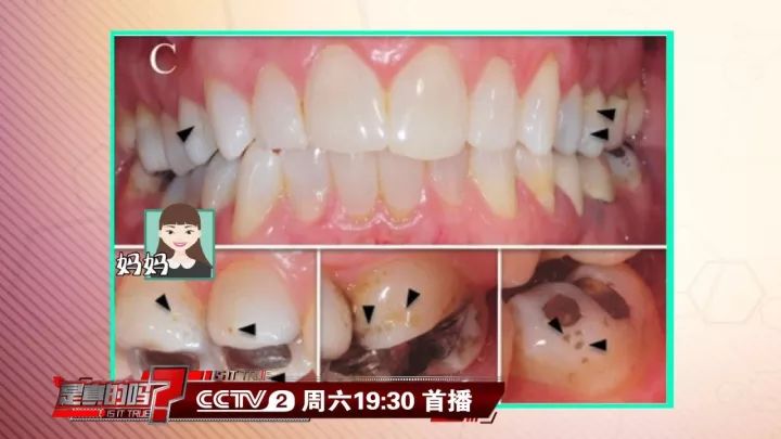 补钙能坚固牙齿吗