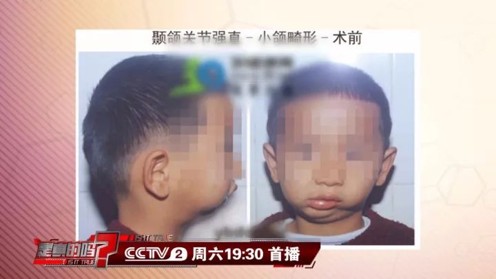 补钙能坚固牙齿吗