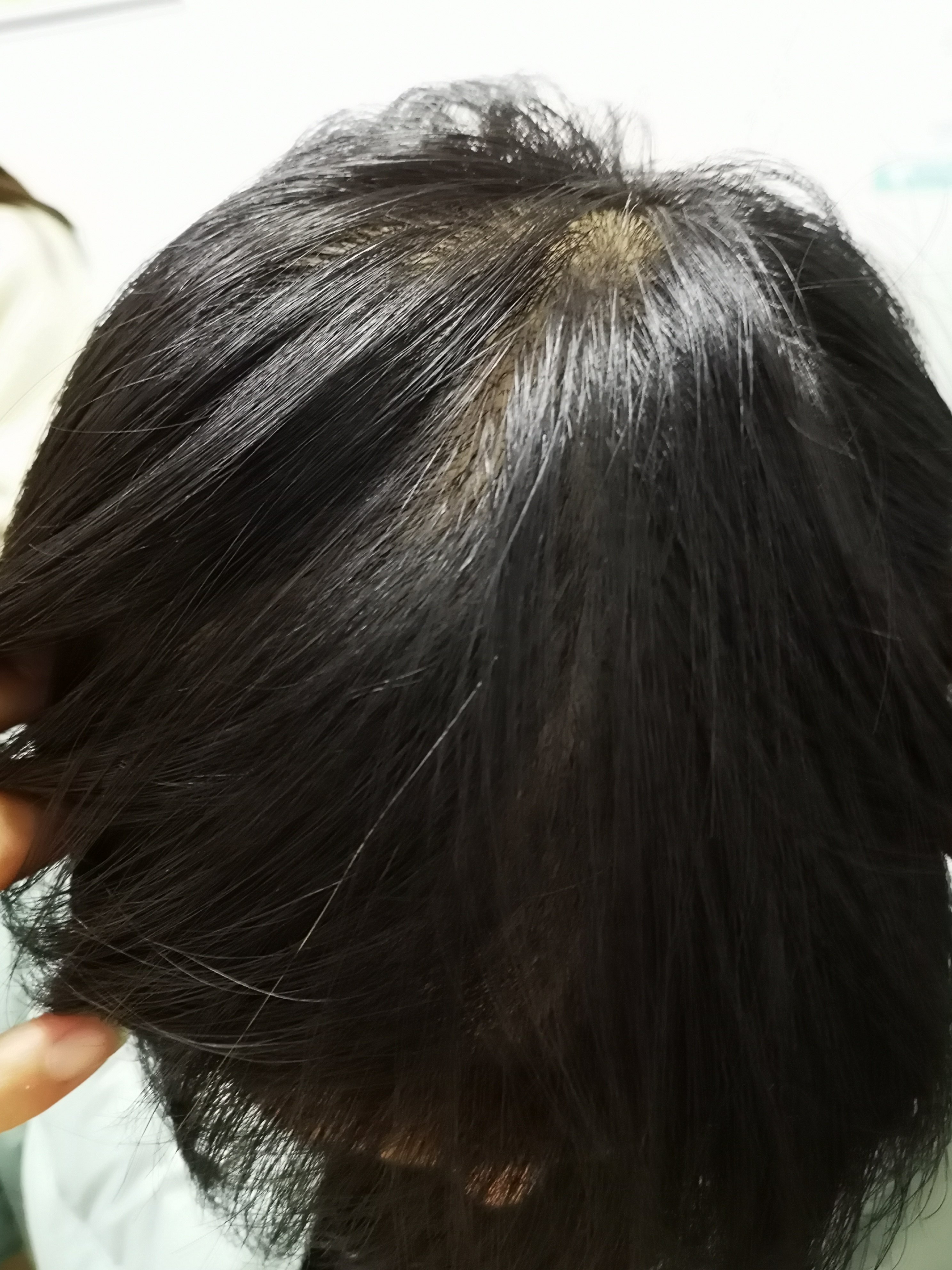 吃锌硒宝脱发