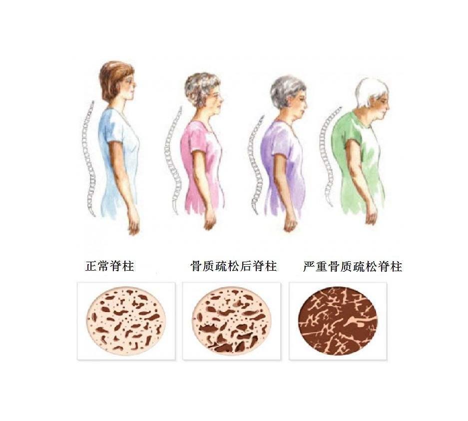 成人如何补钙
