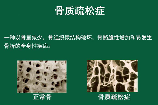 成人如何补钙
