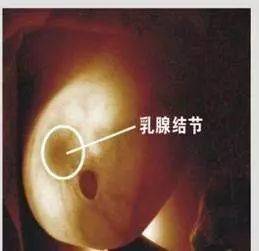 乳腺癌 硒维康