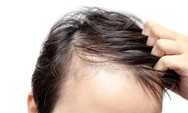 补铁可以防止掉头发吗