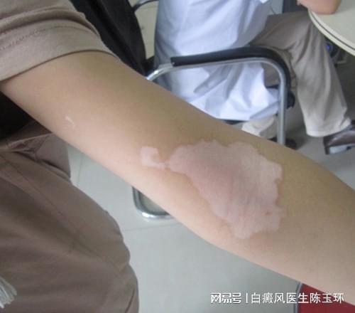 白癜风如何补硒