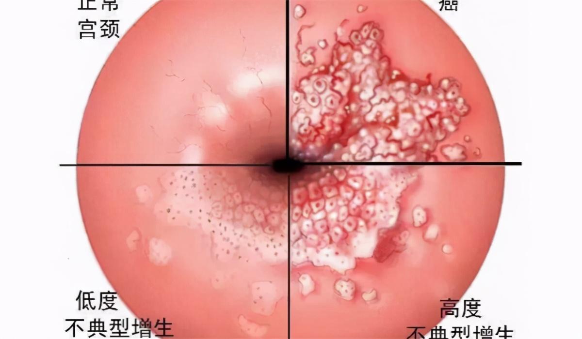 补硒对宫颈好吗