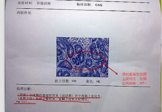补硒能治疗肠胃