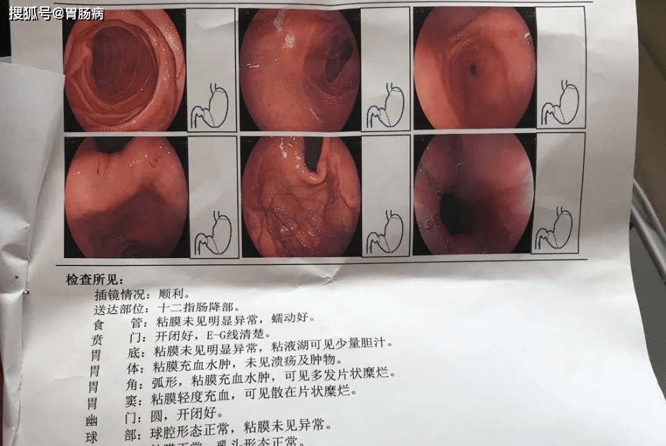 补硒能治疗肠胃