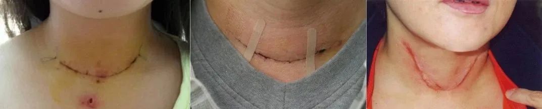 甲状腺全切补硒
