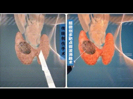 甲状腺全切补硒
