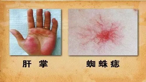 丙肝可以补硒吗