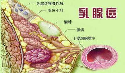肠癌还能补硒吗