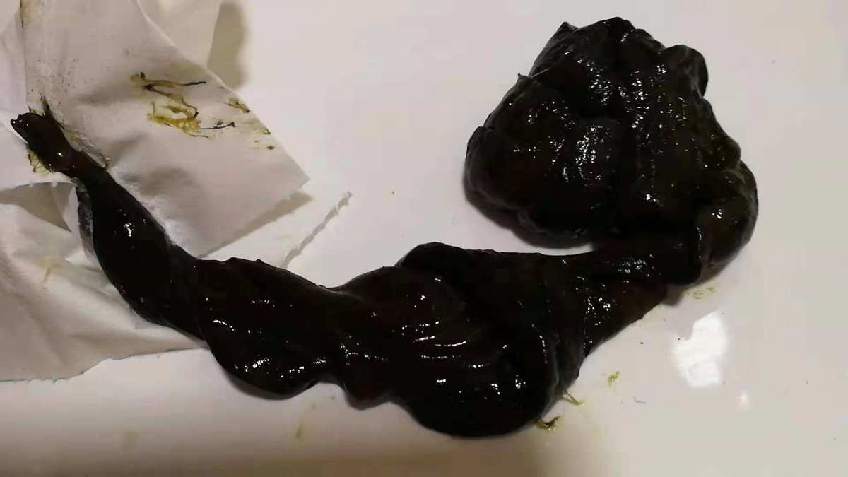 补铁拉屎会是黑色的吗
